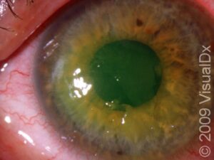 Recurrent Corneal Erosion Causes Symptoms And Treatment