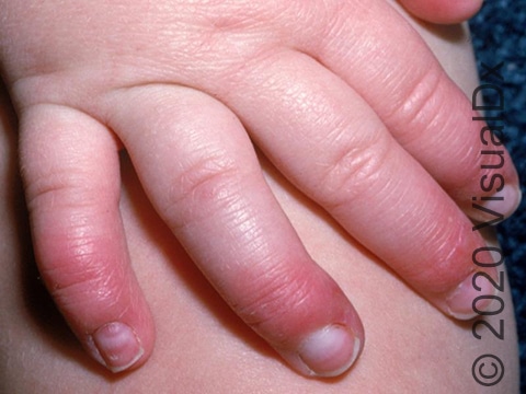 Red patches on the fingers.