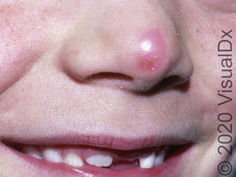 Violet-red discoloration and crusting at the tip of the nose.