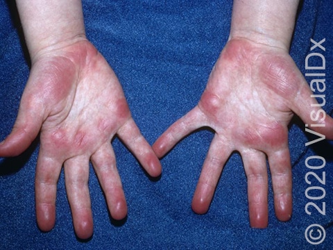 Deep red discoloration on the palms and fingers.