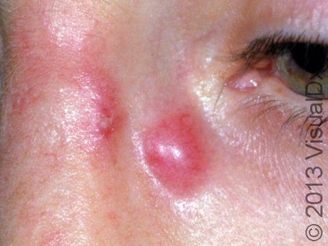 An abscess usually starts as a tender or painful, red and swollen area.