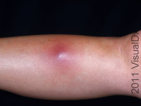 The arm of this teenager displays a typical small abscess.