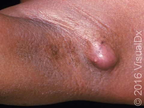 By pushing on this warm, tender abscess with a finger, there is a sense of fluid (pus) that can be felt within the abscess.