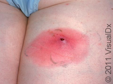 This abscess on the young girl has been incised and drained by the doctor.
