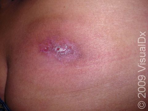 This image displays a confirmed CA-MRSA (community-associated methicillin-resistant Staphylococcal aureus) abscess.