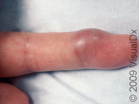 Small abscess on finger in a teenager.