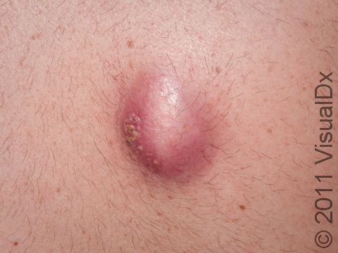 This is a typical abscess, which develops as a painful red or violaceous lump. Pushing on this with a finger or blunt instrument causes extreme tenderness. 