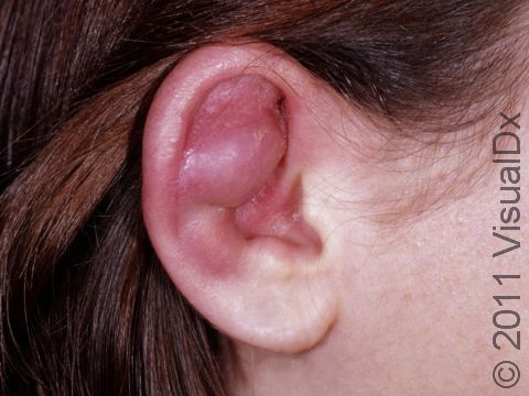 Abscesses can occur at the site of an injury. In this case, an abscess developed after ear cartilage piercing. Note the pus-filled area at the center.