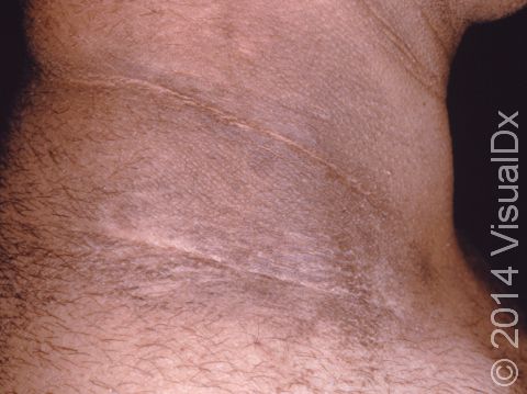 This image displays acanthosis nigricans, which affects the body folds, most frequently the neck and armpits.