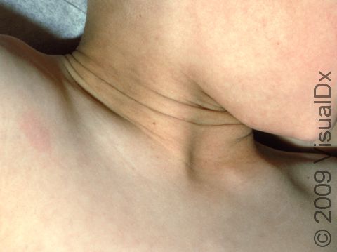 This image displays a subtle case of acanthosis nigricans.