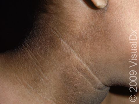 This image displays how acanthosis nigricans can appear to merely be a dirty neck.
