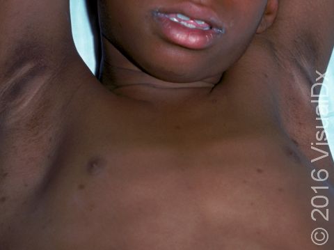 This image displays a child with armpit acanthosis nigricans as well as juvenile diabetes.