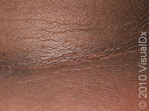 This image displays a close-up of the neck showing the typical velvety skin thickening seen in acanthosis nigricans.