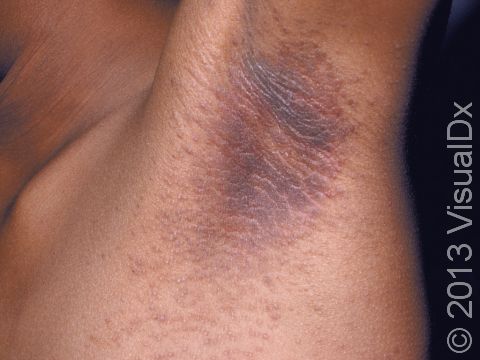 This image displays the velvety-like area of darkened pigment typical of acanthosis nigricans.