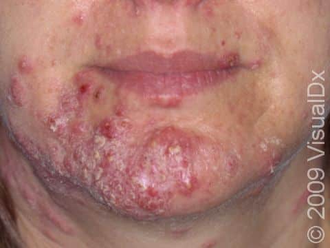 This image displays acne with bloody crusts as a result of manipulating the lesions.
