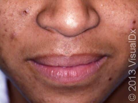 This image displays acne scars and new acne lesions, with crust, on both cheeks.