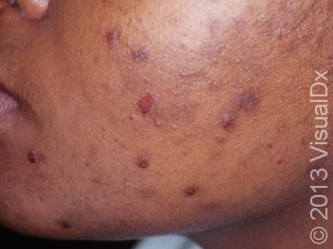 This image displays the result of squeezing and picking at acne on a person with darker skin.