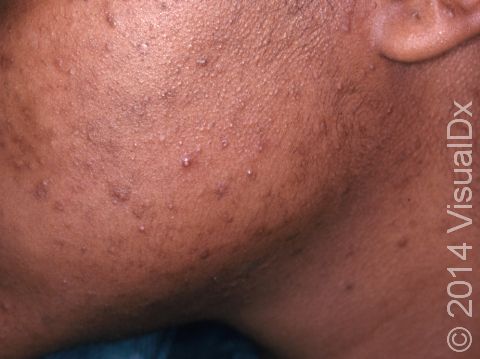 This image displays flat, brown blemishes, a result of acne inflammation of the skin in a Black individual.