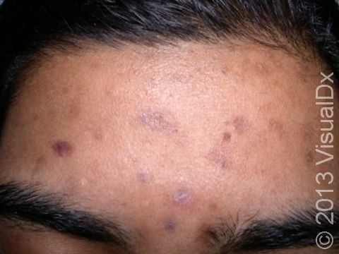 Multiple irregularly shaped scars with no typical acne bumps indicate that the lesions have been squeezed and picked.