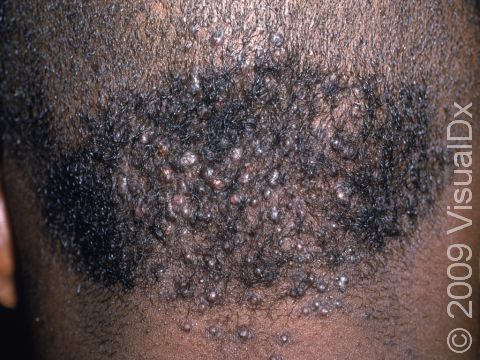 This image displays fairly small lesions of acne keloidalis nuchae.