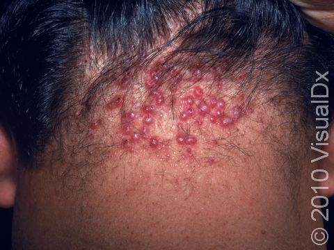 This image displays the back of the neck at the hairline that is affected by acne keloidalis nuchae.