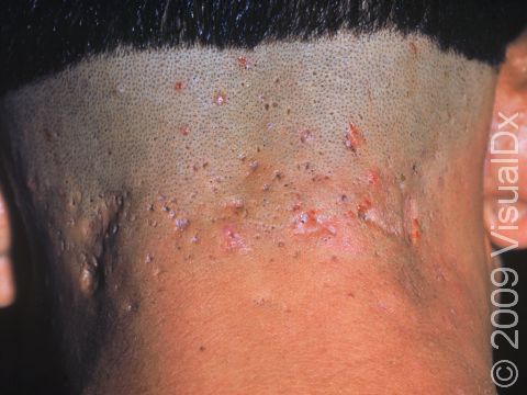 This image displays a person with a variant of acne keloidalis nuchae, displaying depressed scars rather than thick keloids.