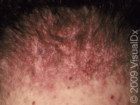 Acne Keloidalis Nuchae Condition, Treatments and Pictures for Teens -  Skinsight