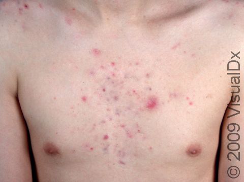 This image displays cysts and deep inflammatory lesions on the chest caused by acne.