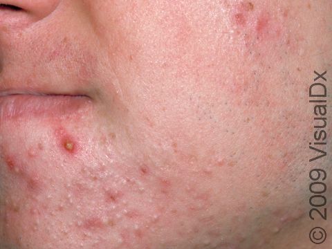 This image displays pus-filled lesions with whiteheads and blackheads (closed and open comedones) in an adult with moderate acne.