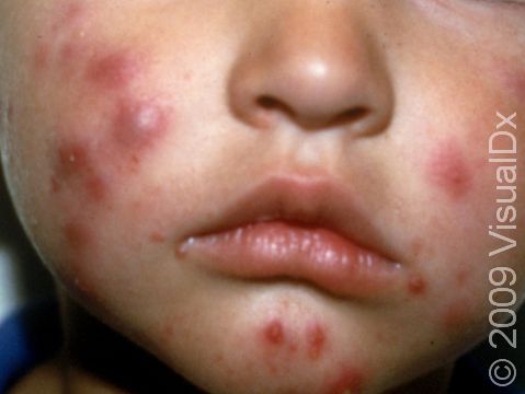 This image displays cystic acne, which rarely occurs in children.