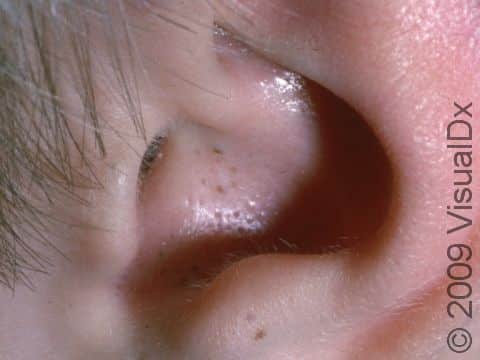 The area inside the ear can sometimes have acne lesions; in this case, blackheads (open comedones).