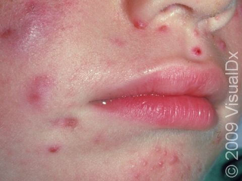 This image displays a three-year-old child with large cysts and multiple acne bumps on the nose and chin.