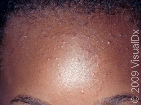 This image displays several whiteheads (closed comedones) on the forehead.