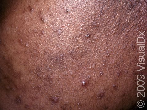 This image displays pus-filled lesions and blackheads (open comedones), as well as darkened areas from previous acne lesions.
