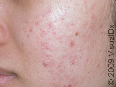 This image displays bumps, pus-filled lesions, and dark, flat pigmented marks from previous acne lesions.