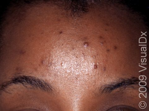This image displays small acne pus-filled lesions as well as darker marks from previous lesions on the forehead.