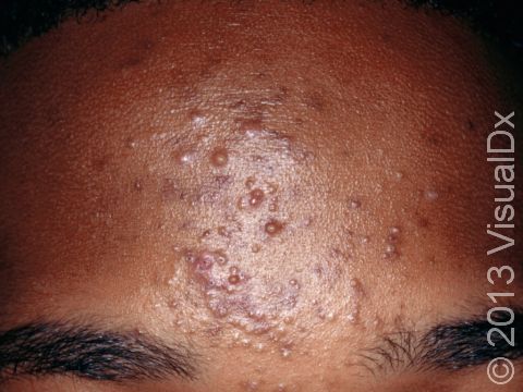 This image displays bumps, pus-filled lesions, whiteheads (closed comedones), and flat, brown marks from old lesions typical of acne.