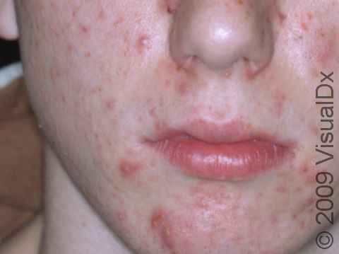 This image displays bumps, pus-filled lesions, and residual flat, red marks typical of acne.