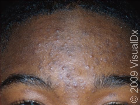 This image displays multiple bumps of inflammatory acne with faint redness of each lesion.