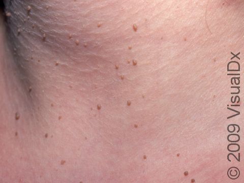 This image displays small, benign skin polyps called acrochordons (skin tags).