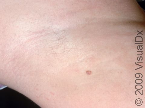 This early adolescent has a single harmless skin tag (acrochordon) on the armpit.