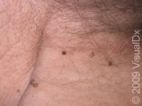 Skin tags are common benign (non-cancerous) skin polyps.
