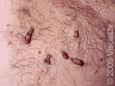 Skin Tag (Acrochordon) Condition, Treatments and Pictures for