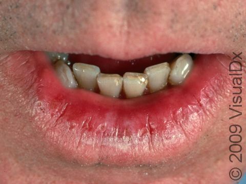 This image displays scaly, dry, cracked lips due to actinic cheilitis.