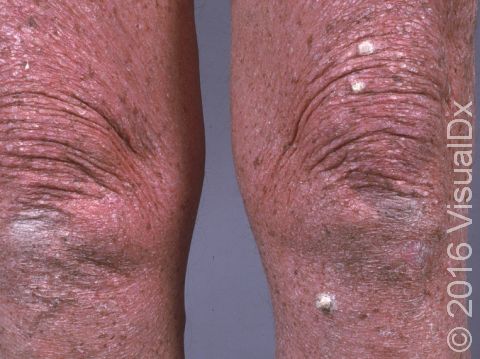 This image displays actinic keratosis of the legs.