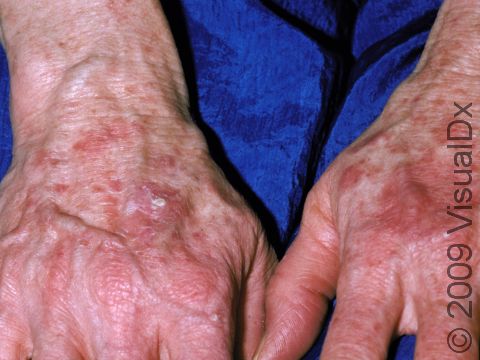 Actinic keratoses are pre-cancerous, due to too much sun-exposure over years, which appear as small, scaly lesions that are rough to the touch.