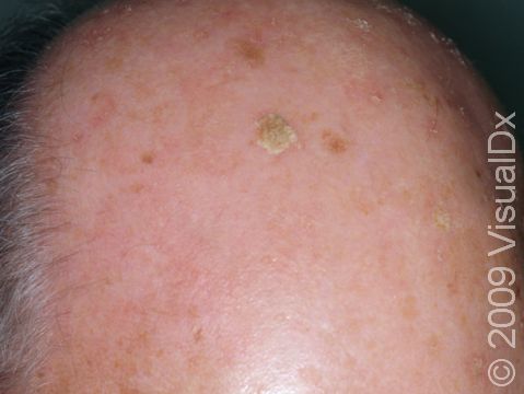 This image displays a bald scalp with areas of sun damage and actinic keratoses.