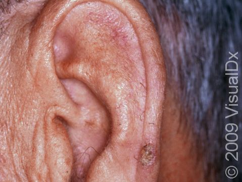 This image displays a frequent site for actinic keratoses, the rim of the ear.