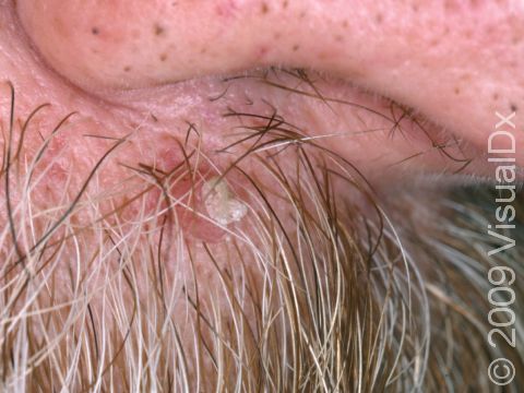This image displays actinic keratoses hidden by facial hair.