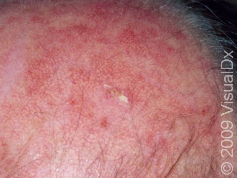 This image displays an actinic keratosis in the center as well as prominent blood vessels, which suggest chronic sun damage.